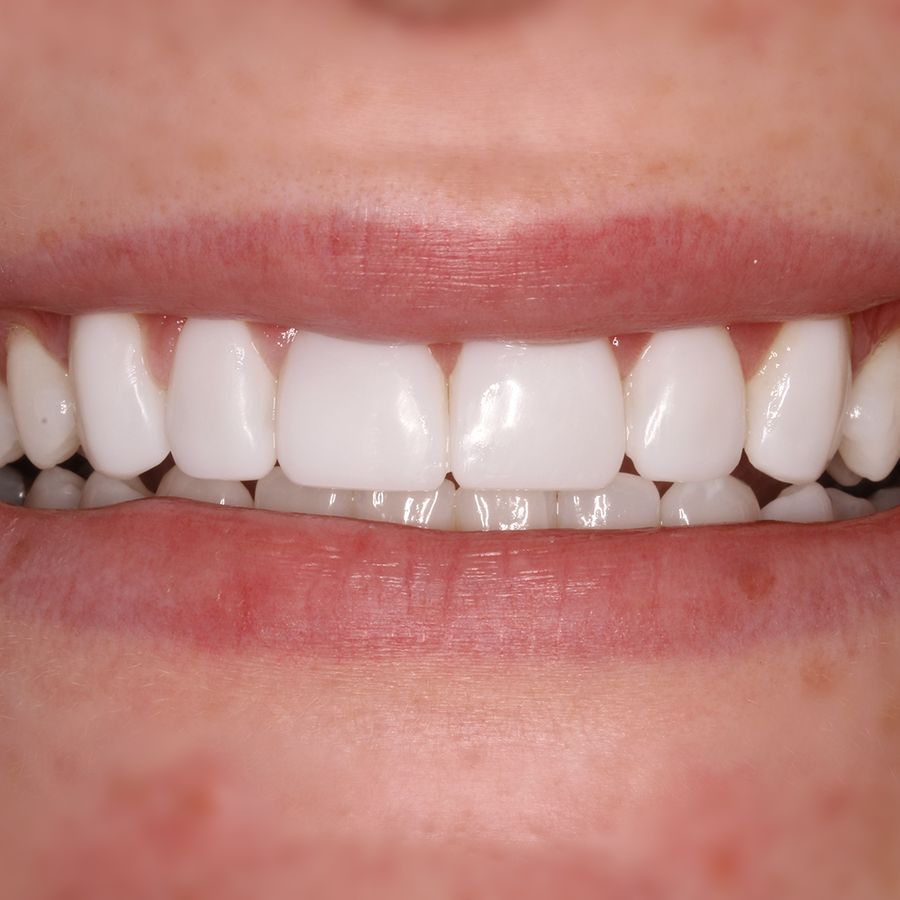 Dental Bonding Post-Treatment Care