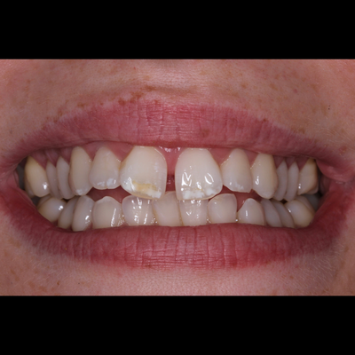 Invisible Braces - DAX Dental - Delray Beach Boca Boyton, Implants,  Dentist, Crowns