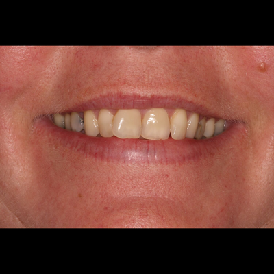 Front teeth repair 🔥###trinidaddentist #trini_tiktoks #cosmeticbondin