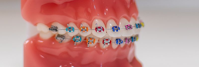 Braces Colours - Show off your personality with colour!